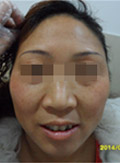 女性面颈部散发型白癜风6个月